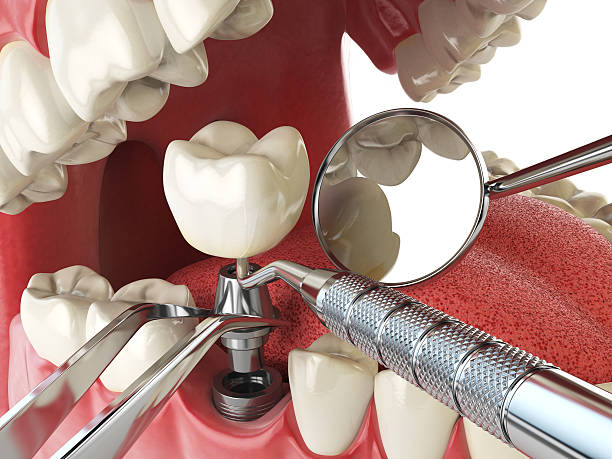 Best Emergency Root Canal Treatment in Bluffdale, UT